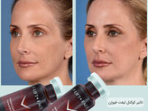 Fusion F-XFC+ FACE کوکتل مزوتراپی تغذیه عمقی پوست