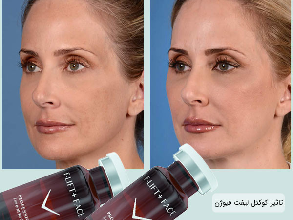 Fusion F-XFC+ FACE کوکتل مزوتراپی تغذیه عمقی پوست