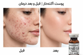 MESOLIKE Brightening Anti Acne کوکتل روشن کننده پوست خرید کوکتل ضد جوش مزولایک از مزومارکت