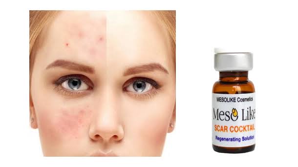 کوکتل مزوتراپی اسکار مزولایک برای بهبود ظاهر جای زخم