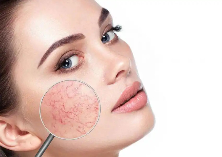 Fusion F-COUPERIX برای درمان قرمزی پوست
